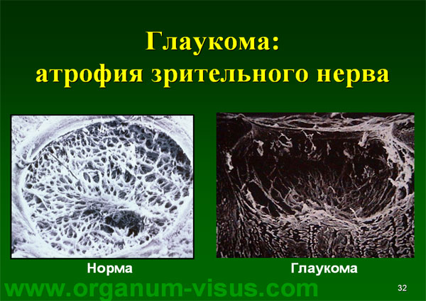 Organum-visus_Глаукома_Школа офтальмологического пациента_2008_1003_Лечение глаукомы_Глазные капли_Проcтагландины_Латанопрост_Травопрост_Ксалатан_Траватан_Тимолол_Образ жизни при глаукоме_Glaucoma