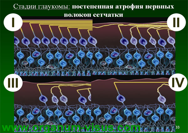 Organum-visus_Глаукома_Школа офтальмологического пациента_2008_1003_Лечение глаукомы_Глазные капли_Проcтагландины_Латанопрост_Травопрост_Ксалатан_Траватан_Тимолол_Образ жизни при глаукоме_Glaucoma