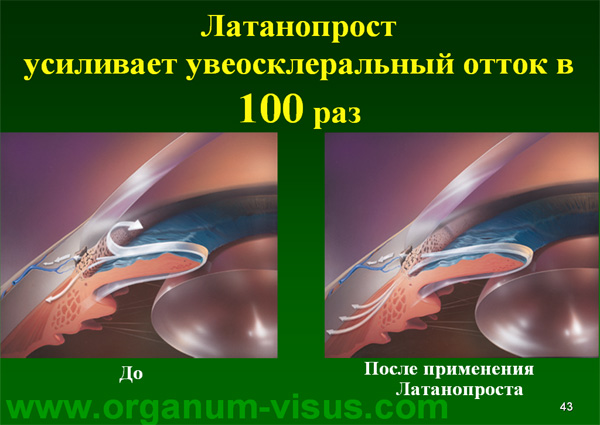 Organum-visus_Глаукома_Школа офтальмологического пациента_2008_1003_Лечение глаукомы_Глазные капли_Проcтагландины_Латанопрост_Травопрост_Ксалатан_Траватан_Тимолол_Образ жизни при глаукоме_Glaucoma