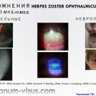 Чернакова Г.М.,  Клещева Е.А. Аспекты  противовоспалительной терапии при Herpes Zoster Ophthalmicus: итоги и перспективы. Доклад на Всероссийской школе офтальмолога-2016 (ВШО-2016, "Снегири"). Информационный партнер organum-visus.com (Рис. 4)
