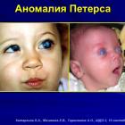 Катаргина Л.А., Мазанова Е.В., Тарасенков А.О. Врожденная глаукома: клинические проявления, этиология, классификация, современные методы диагностики, дифференциальный диагноз ”большого глаза’. Школа детского офтальмолога, 15.09.2016, Москва. Информационный партнер портал Орган зрения organum-visus.ru (рис.39)
