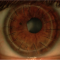 16 швов на роговице. Пересадка роговицы, corneal transplants.
