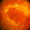 Exudative retinal detachment.