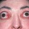 Еndocrine ophthalmopathy. Новости офтальмологии портала Орган зрения www.organum-visus.com