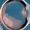 Eye Cancer. Retinoblastoma. Новости офтальмологии портала Орган зрения www.organum-visus.com