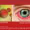 Red Eye. Хламидийная инфекция переднего отрезка глаза. Новости офтальмологии портала Орган зрения www.organum-visus.com
