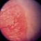 Ретинопатия недоношенных, retinopathy of prematurity.